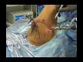 Techniques for Safe Portal Placement in the Shoulder: The Ring of Fire