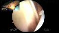 Peroneal Tendoscopy: An Innovative Perspective for Peroneal Tendon Pathology