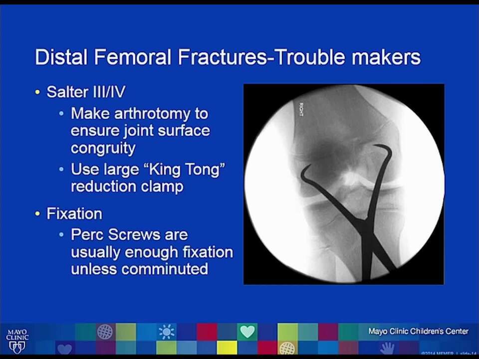 Physeal Fractures Around the Knee: How to Stay Out of Trouble