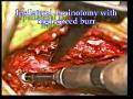 Lumbar Spinal Stenosis: Laminoplasty