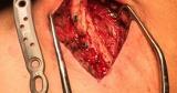 Surgical Fixation of Displaced Midshaft Clavicle Fracture