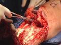 Transtibial Amputation
