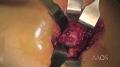 Approaches to the Hip: Minimally Invasive Postero Lateral Total Hip Arthroplasty