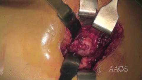 Approaches to the Hip: Minimally Invasive Postero Lateral Total Hip Arthroplasty