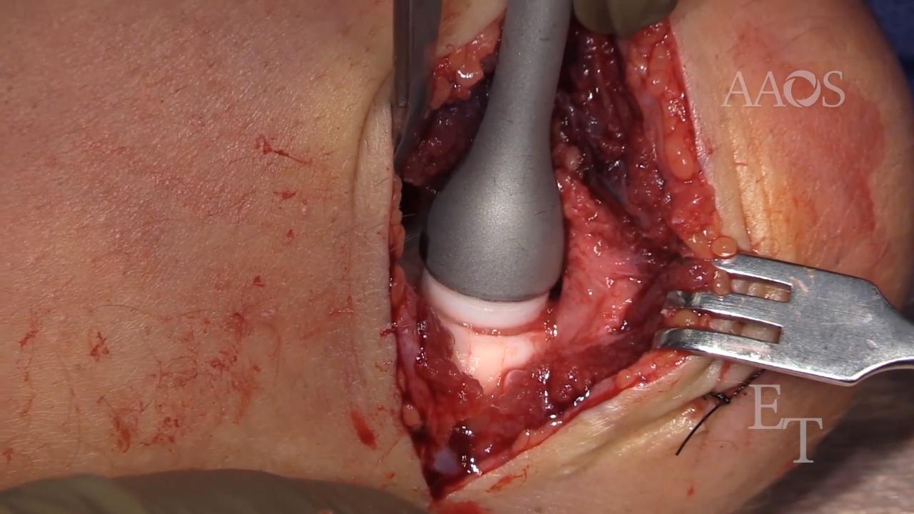 Osteochondral Autograft Transfer for Osteochondritis Dissecans Lesion of the Humeral Capitellum in an Adolescent Pitcher