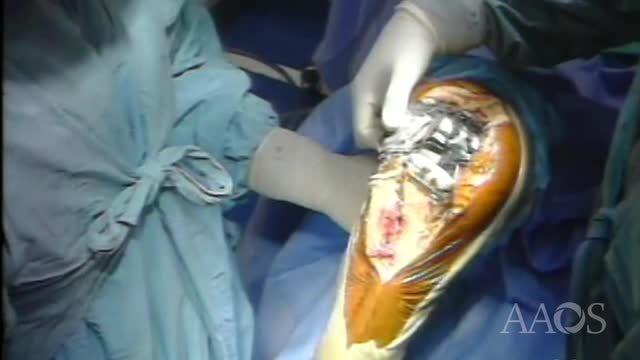 Anterior Midline Exposure: Tibial Tubercle Osteotomy with Wire Fixation
