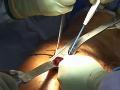 Anterolateral Approach in Minimally Invasive Total Hip Arthroplasty