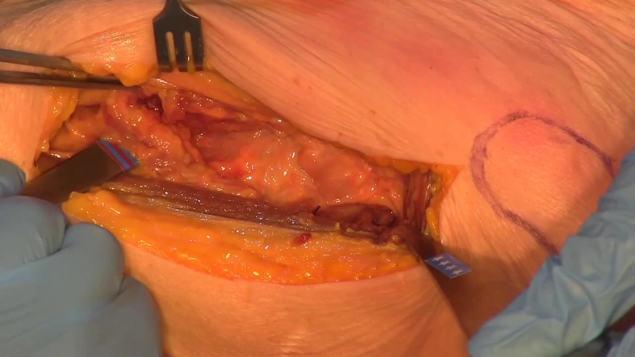 Anterior and Anteriolateral Approaches to Femoral Neck