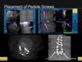 3D Fluoroscopic Imaging / Intra-Op CT with Navigation