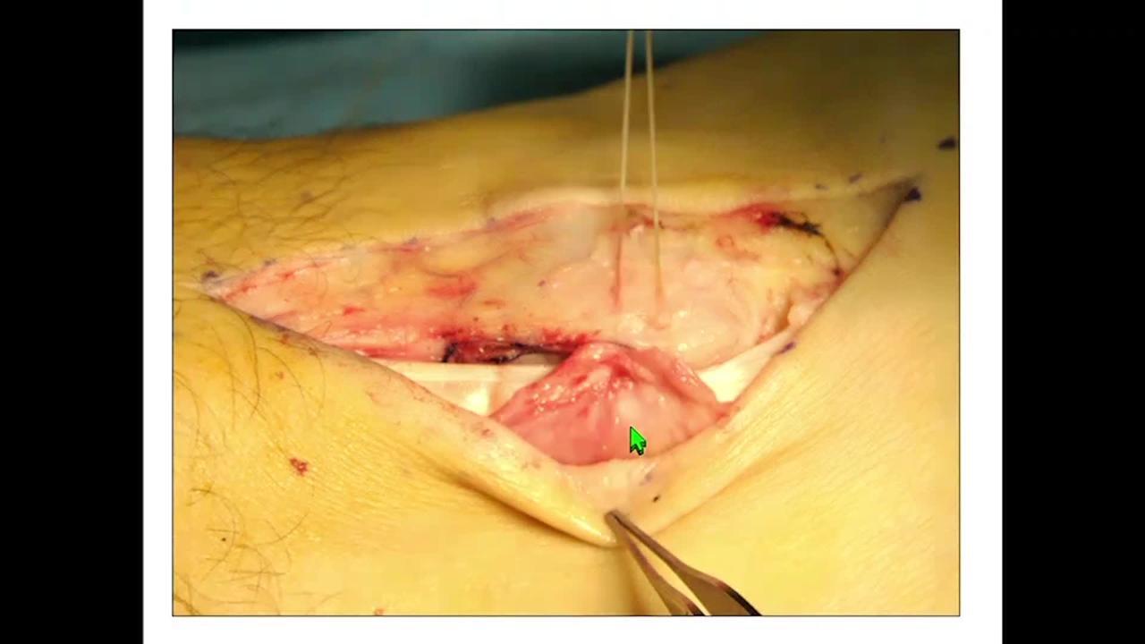 Peroneal Anatomy, Vascularity, and the Os Peroneum