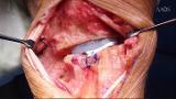 Total Wrist Arthroplasty - Indications, Technique, and Outcomes, 