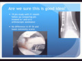 Controversies in Ankle Fractures: Distal Tibiofibular Syndesmosis Injury and Arthroscopic-Assisted Fixation