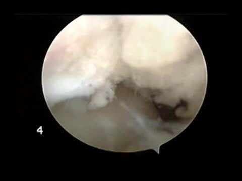 Advanced Ankle Arthroscopy - Conventional Treatment, Microfracture, Abrasion Drilling