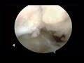Arthroscopic Surgical Techniques: Advanced Ankle Arthroscopy - Conventional Treatment, Microfracture, Abrasion Drilling