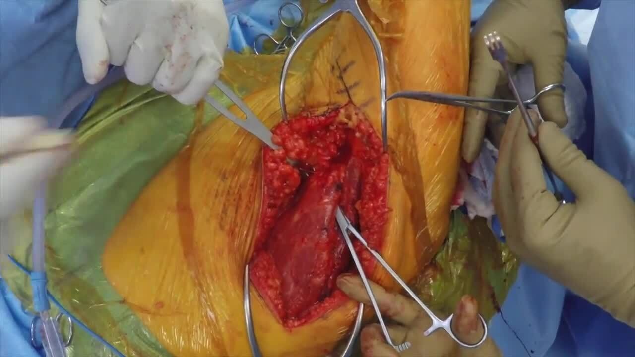 Latissimus Dorsi Tendon Transfer with Acromion Osteotomy for Massive Irreparable Rotator Cuff Tear
