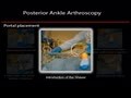 Subtalar Arthroscopy: Posterior Approach
