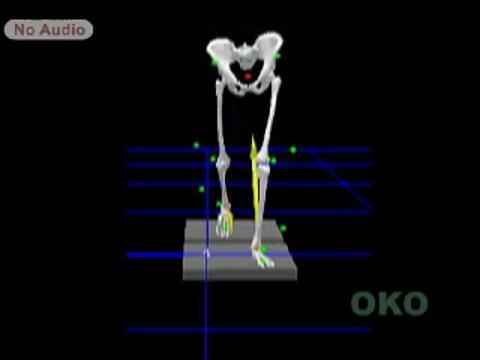 The Orthopaedic management of cerebral palsy: Coronal plane (front view). Gait assessment