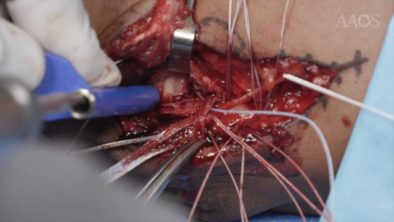 Ulnar Collateral Ligament Repair With Suture Tape Augmentation and Flexor Pronator Repair