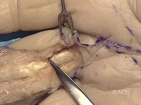 Volar Approach to the Fingers and Palm Using the Brunner Incision