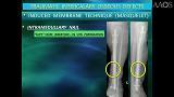 Extracorporeal Fabrication of a Polymethylmethacrylate Spacer: A Minor Masquelet Modification 