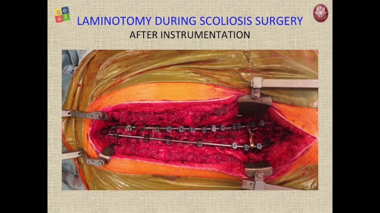 Scoliosis Surgery and Spinal Muscle Atrophy: A New Procedure to Provide Lumbar Access for Intrathecal Administration of Nusinersen