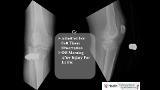 Complex Proximal Tibia Fractures: Workup, Surgical Approaches, and Definitive Treatment Options