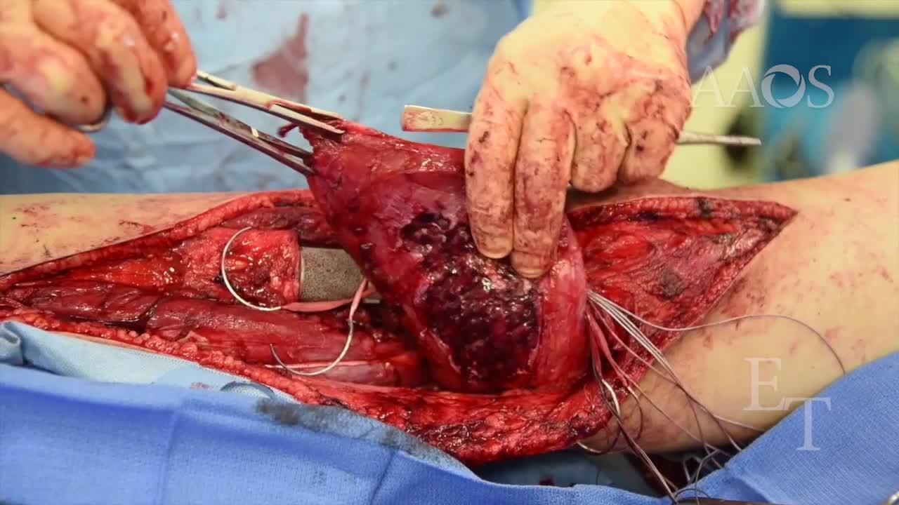 Radical Resection of Proximal Tibia Osteosarcoma
