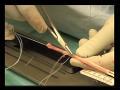 Pediatric Anterior Cruciate Ligament Reconstruction