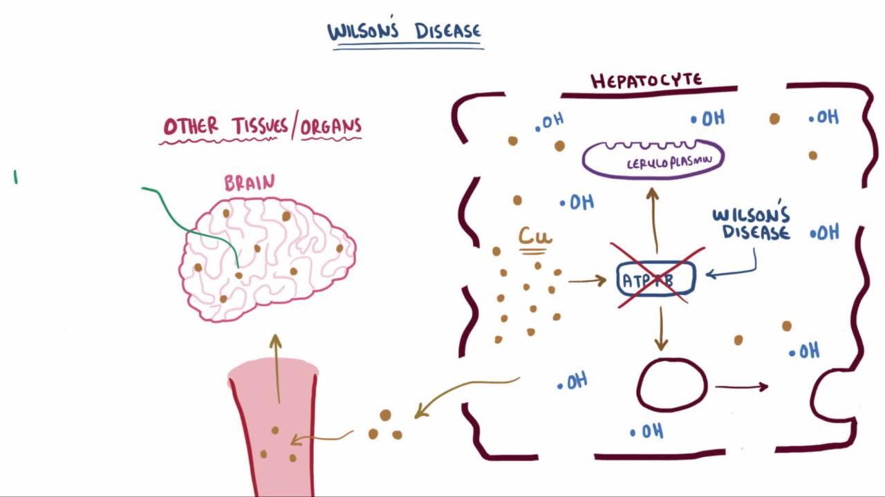 Wilson Disease Nutritional Disorders Msd Manual Professional Edition