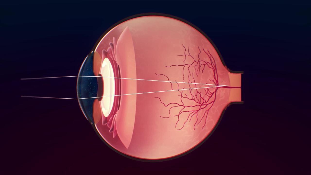 К оптической системе глаза относятся хрусталик. Ангиосклероз сетчатки. ОИ ангиосклероз сетчатки глаза. Гипертонический ангиосклероз сетчатки. Оптическая нейропатия глаза.