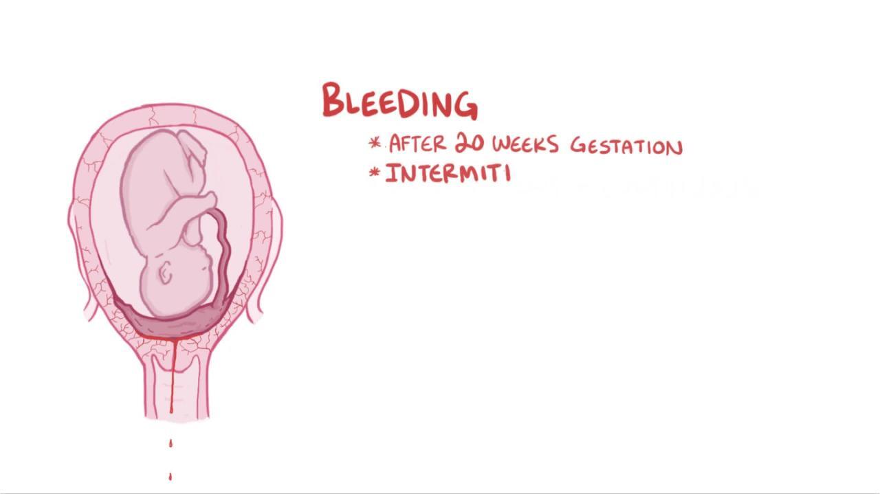 meaning of placenta presentation