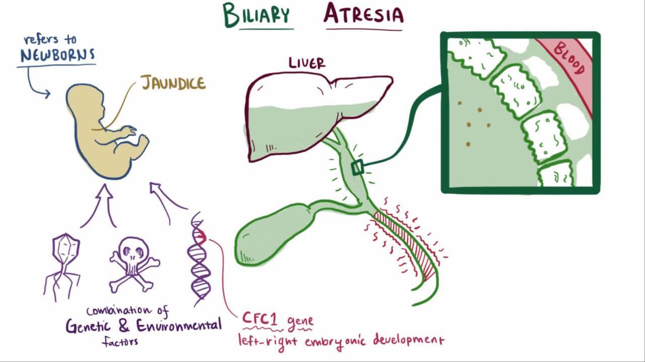 Biliary Atresia - Pediatrics - Merck Manuals Professional Edition