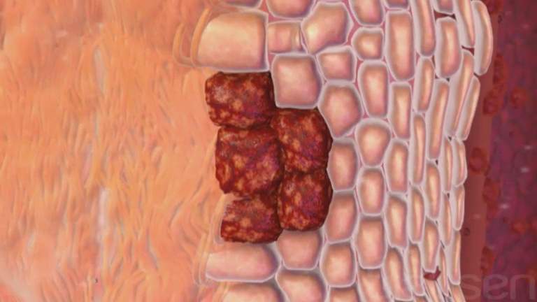 Плоскоклеточный рак пищевода