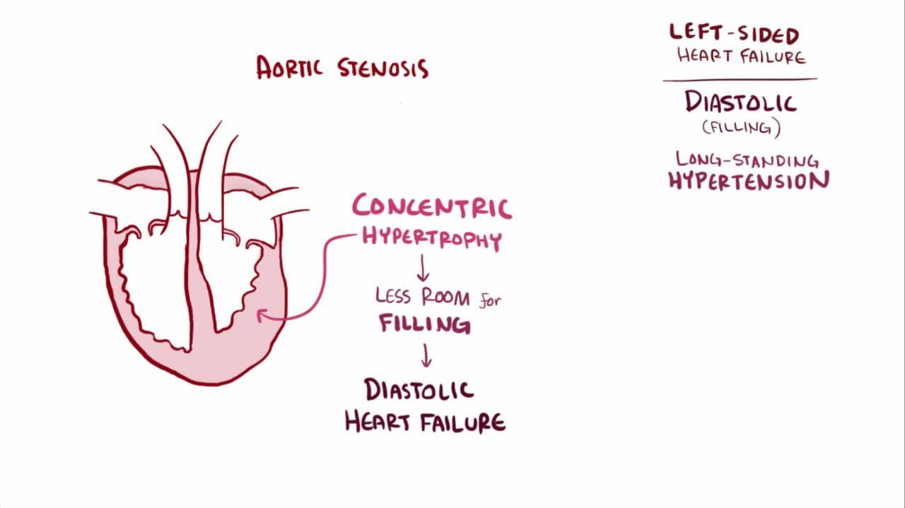 LVSD - Left Ventricle Systolic Dysfunction, Cause Symptoms Treatment, Hindi