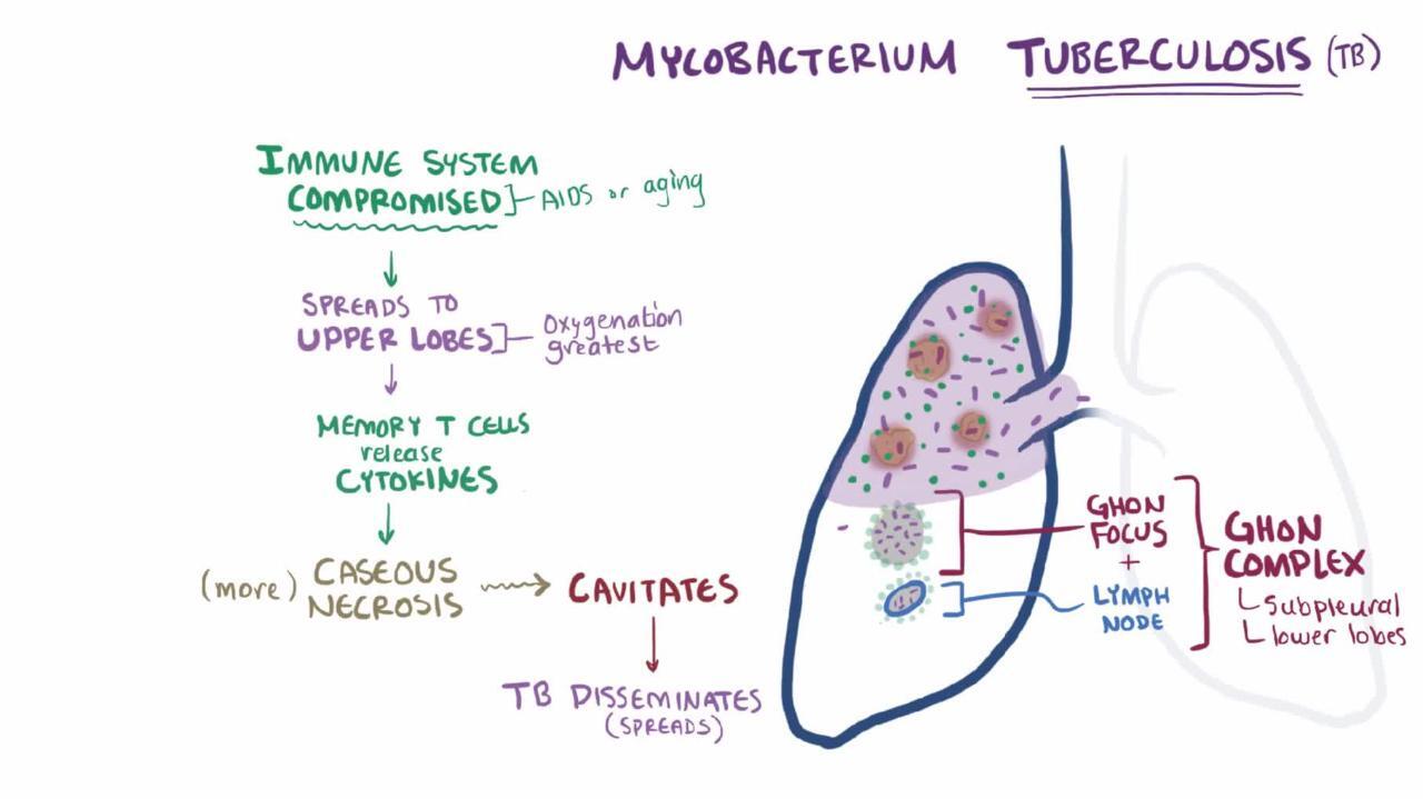 Tuberculosis (TB) - Infectious Diseases - MSD Manual Professional Edition