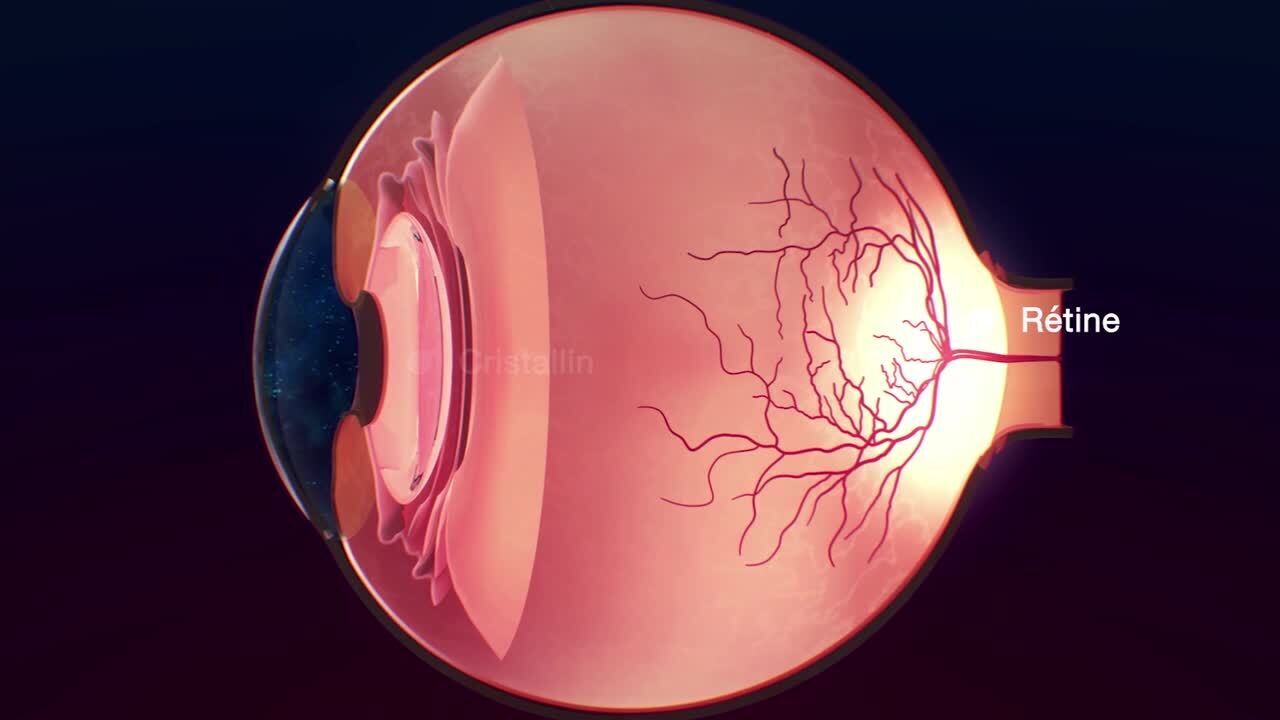 Нейропатия глаза. Ишемическая нейрооптикопатия зрительного нерва. Ишемическая нейропатия сетчатки. Ишемическая нейропатия глазное дно. Передняя ишемическая нейропатия зрительного нерва.