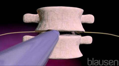 Fusión vertebral (o raquídea) lumbar