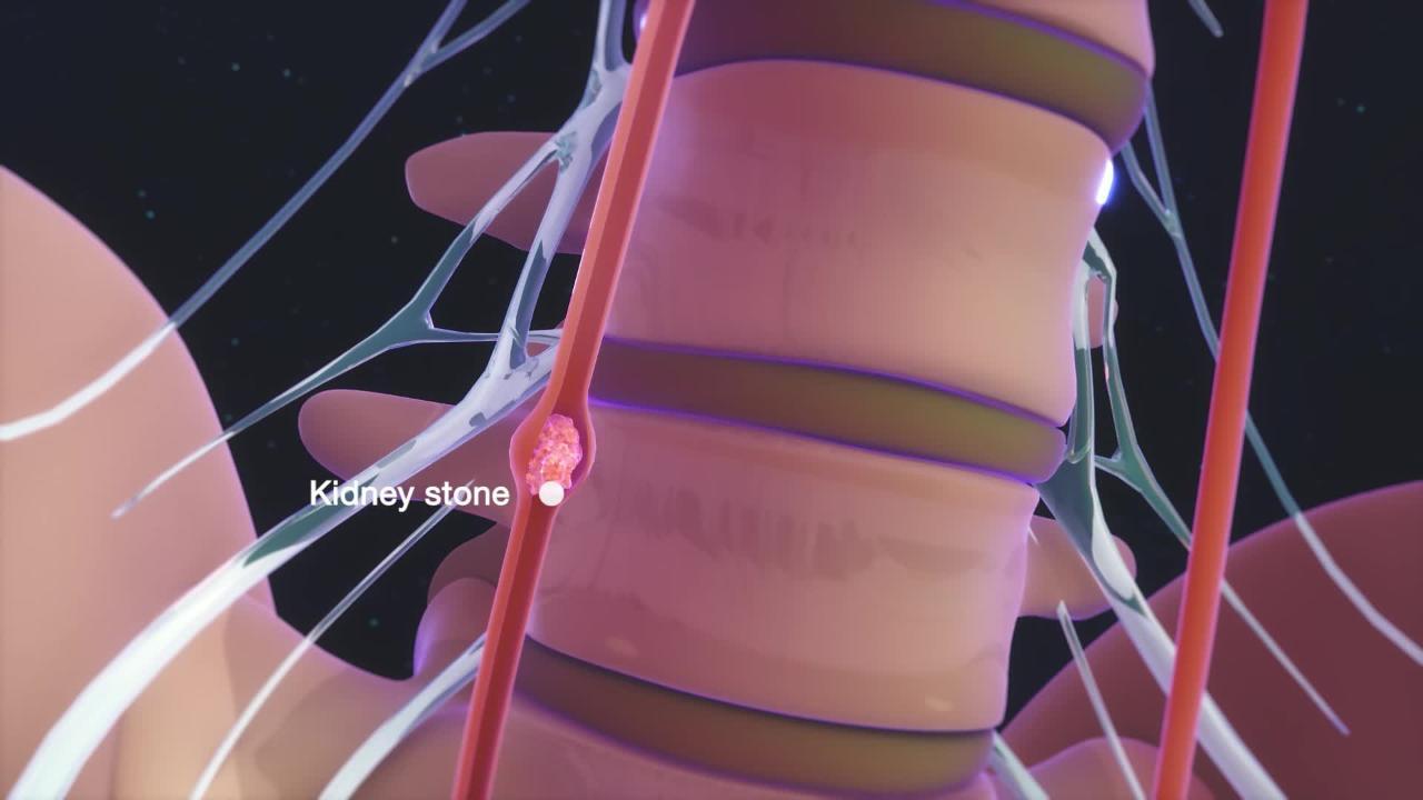 Patient with Acute Onset of Right Flank Pain - Manual of Medicine