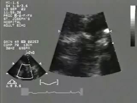 Remplacement de la valve aortique chez le jeune adulte : la procédure de  Ross