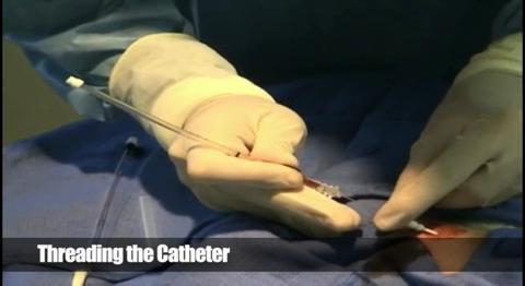 Inserción de un catéter arterial en la arteria radial