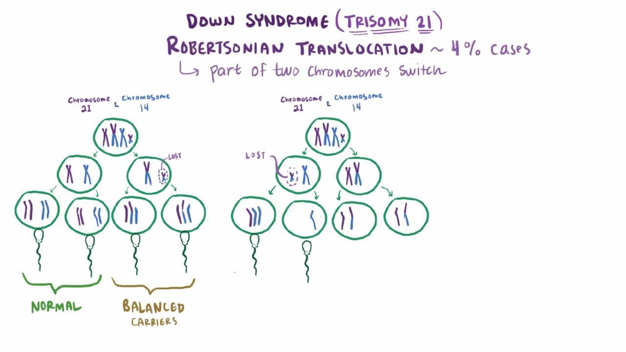 Down Syndrome Trisomy 21 Pediatrics Merck Manuals Professional