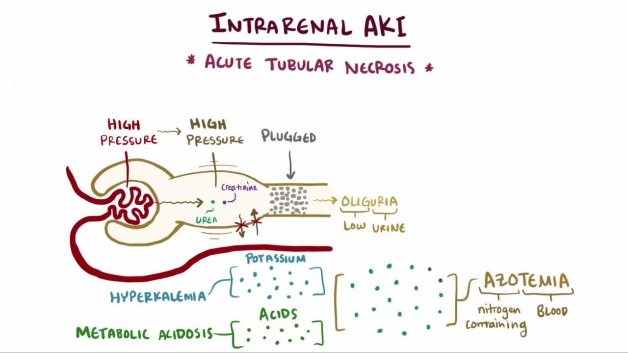 Acute Kidney Injury (AKI) - Genitourinary Disorders - MSD Manual