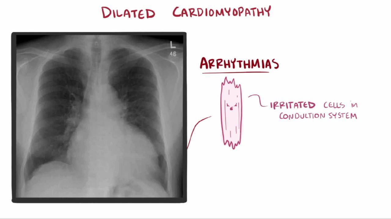Pediatric Dilated Cardiomyopathy Workup: Approach Considerations, Blood  Studies, Chest Radiography