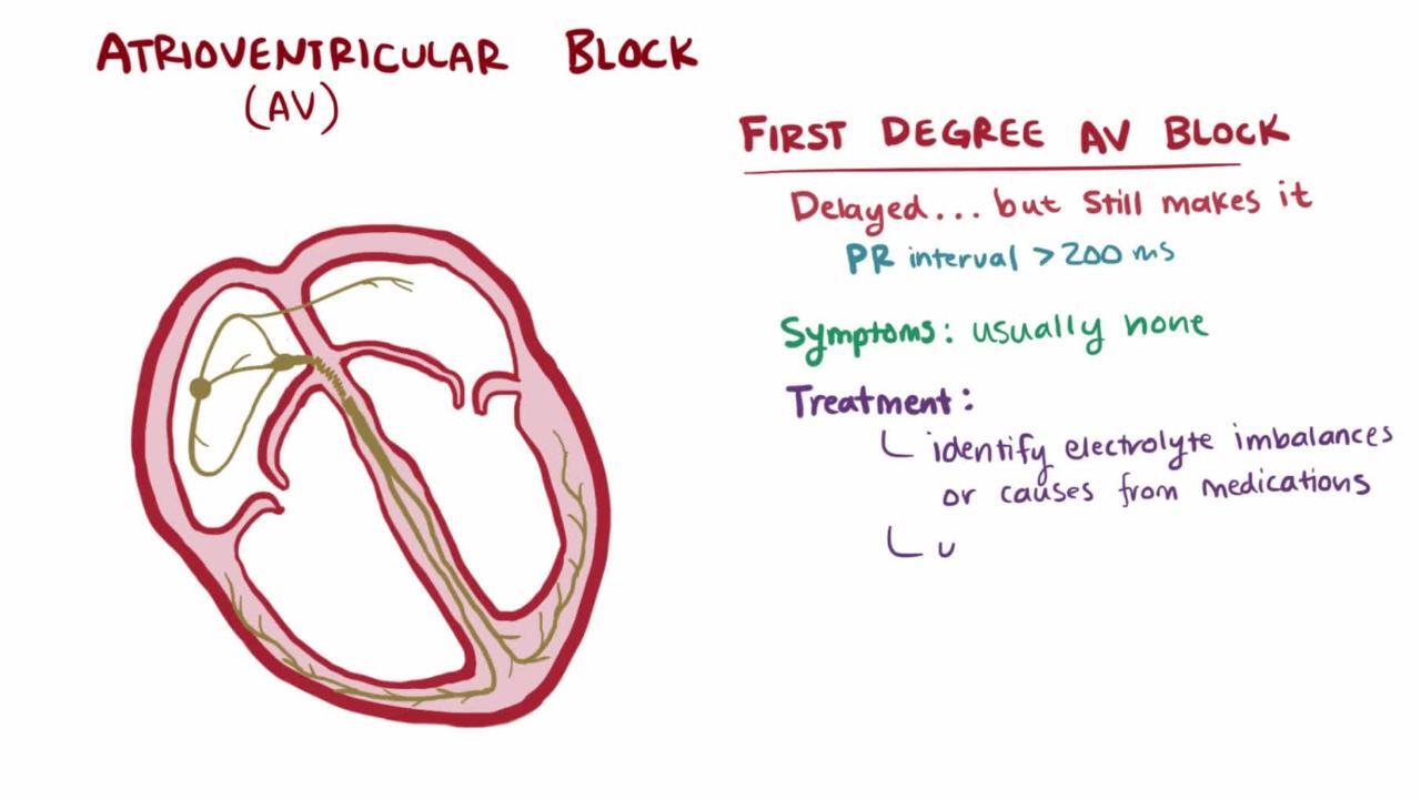 Atrioventricular Block - Cardiovascular Disorders - MSD Manual