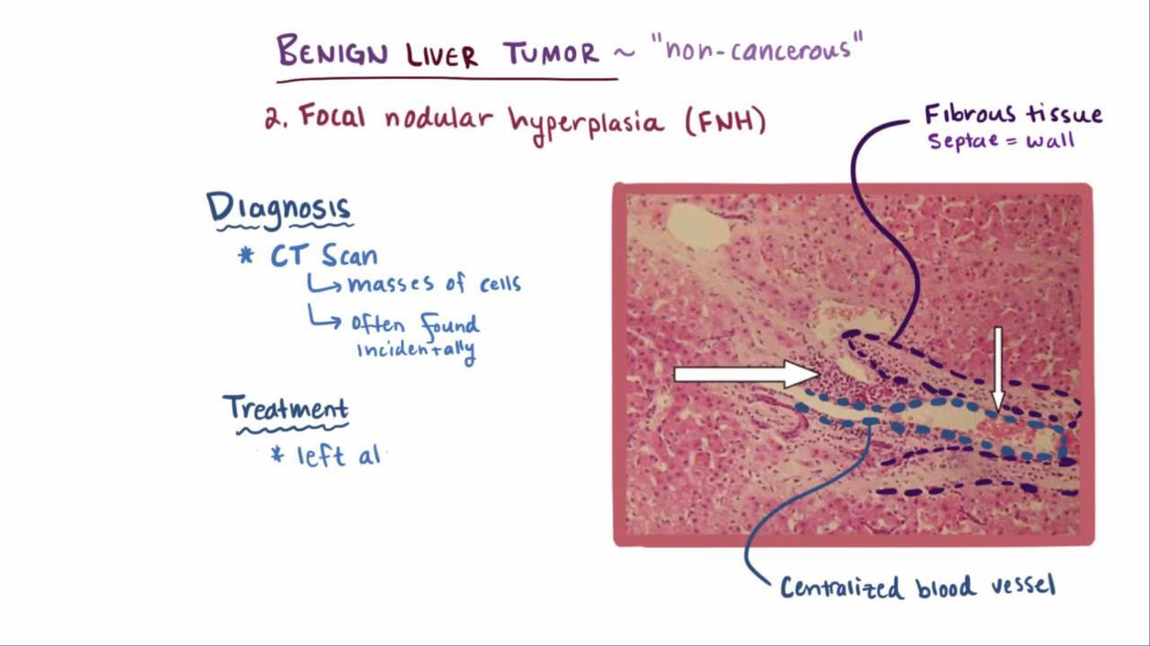 benign tumor histology