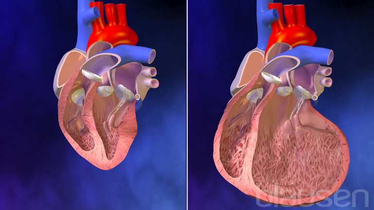 Insuficiencia cardíaca - Trastornos del corazón y los vasos sanguíneos -  Manuale Merck versión para el público general