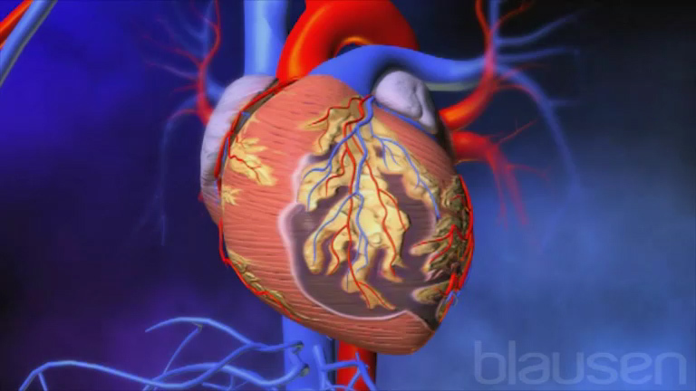 Présentation de la maladie des artères coronaires (MAC) - Troubles  cardiaques et vasculaires - Manuels MSD pour le grand public