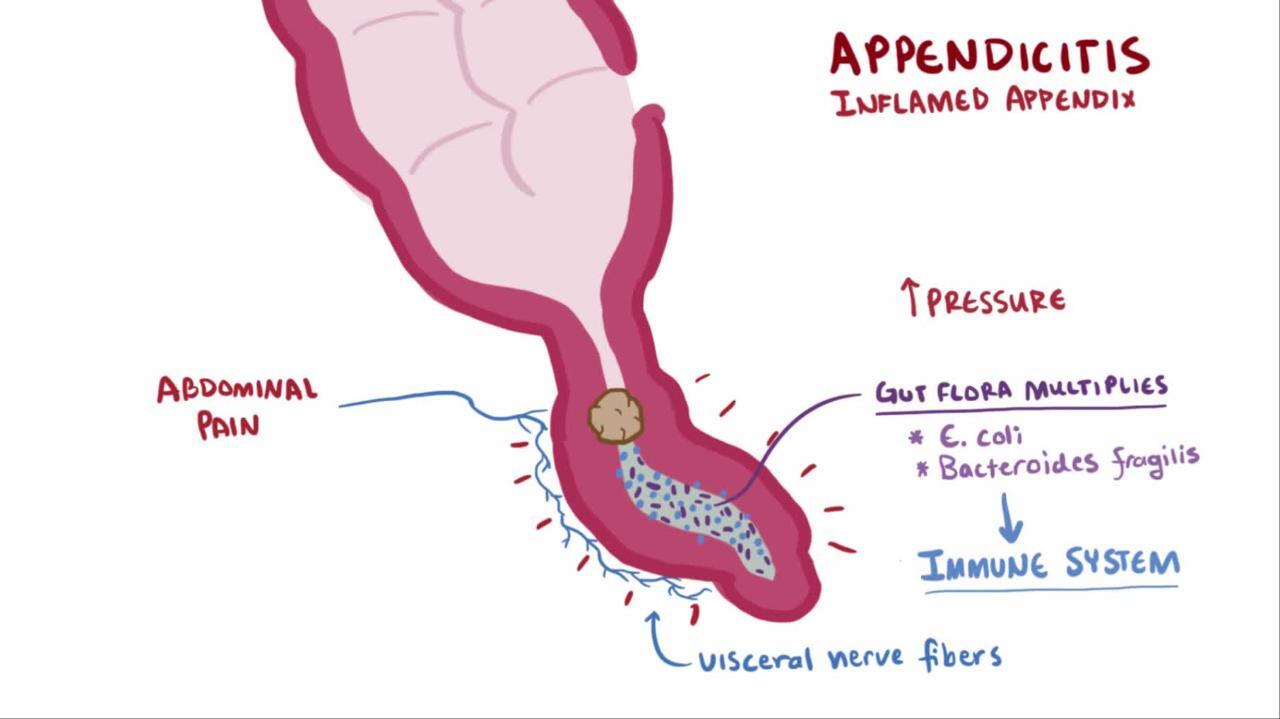 Symptoms Early Appendicitis Ultrasound