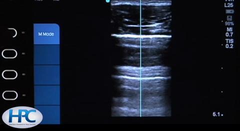 Bilan échographique rapide en cas de choc et d'hypotension (Rapid  Ultrasound for Shock and Hypotension [RUSH])