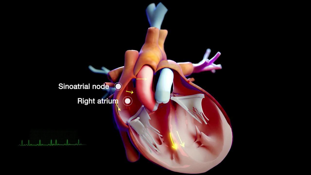 Paroxysmal Supraventricular Tachycardia (SVT, PSVT) - Heart and Blood  Vessel Disorders - Merck Manuals Consumer Version